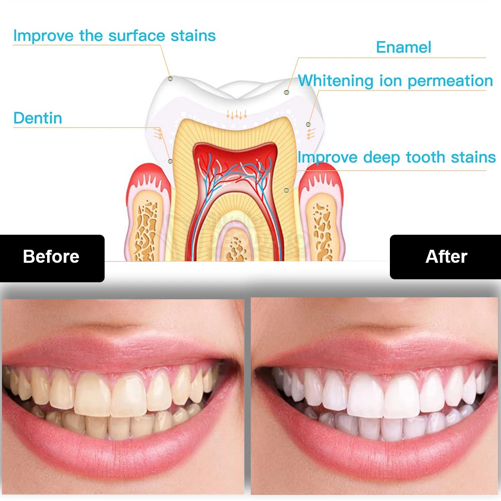 Zestaw do wybielania zębów den – Teeth Whitening Zoom recenzja i cena